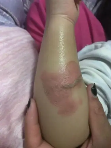 1条回答  会不会留疤痕还不知道,这么大片烫伤本来早就该去医院了