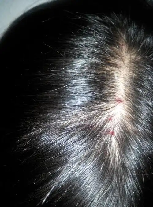 头皮很痒老抓成这样怎么回事怎么办_百度知道