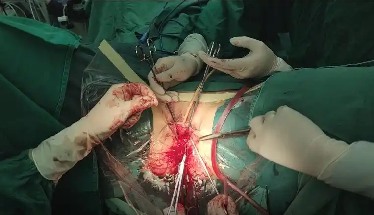 海口市人民医院泌尿外科完成一例尿道憩室手术