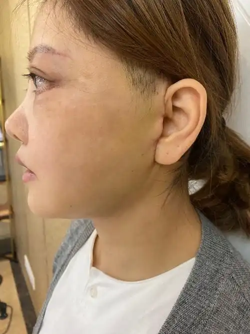 92迷你拉皮年轻化改善术后第二十五天92 94第二十五天_圈子