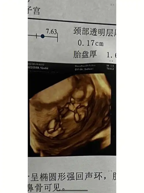 新鲜出炉的孕12周nt照来啦