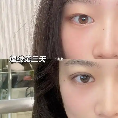 超级自然啊!做完都不肿!太香了#杭州双眼皮  #埋线双眼皮