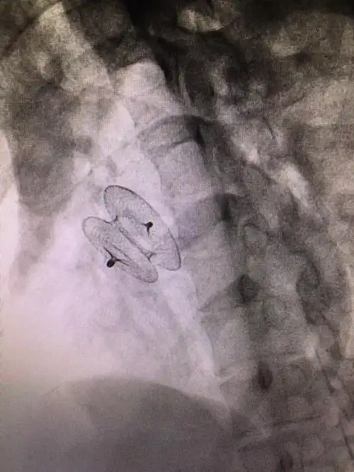 先天性心脏病微创不开刀介入封堵手术,经胸封堵术,小切口或常规切口