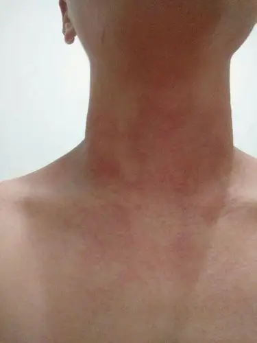 脖子上一片红 而且很痒 怎么办呢