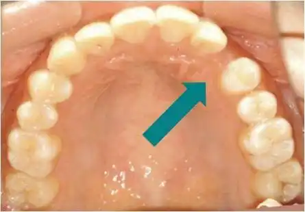 埋伏阻生尖牙的"开窗"牵引助萌