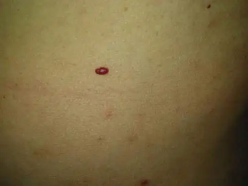 身上长了小红血点,不痛不痒