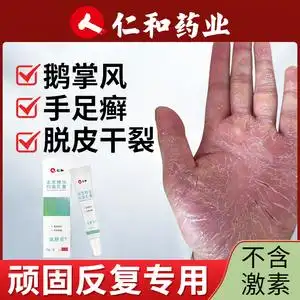 鹅掌风真菌感染手癣膏脱皮干裂手痒汗疱疹水泡手足藓手气专用药膏