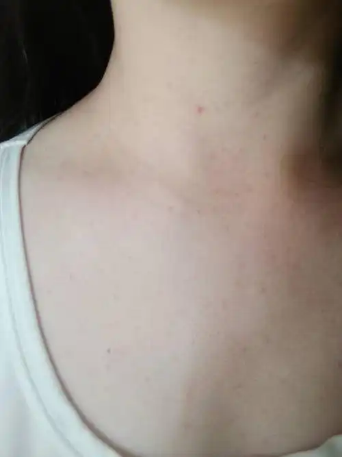 胸前长了很多小红豆,不痒不痛是怎么回事