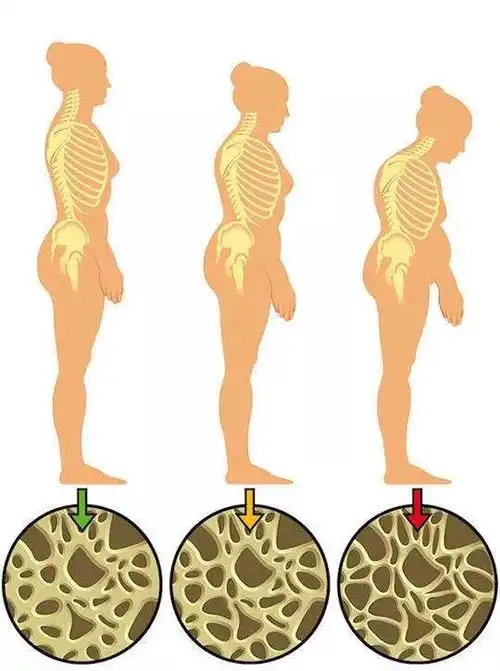 一个喷嚏骨头断了