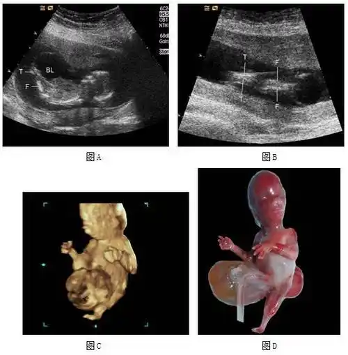 图11 13周5天人体鱼序列征,开放性脊柱裂,巨膀胱 胎儿矢状切面二维(图