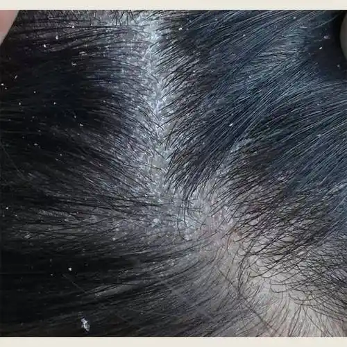 毛囊炎疙瘩用什么洗发水