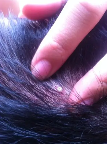 头上毛囊炎 一直没法痊愈 有没有好办法