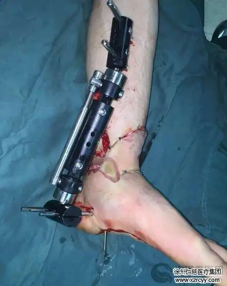 纸板切割机一刀切断左脚 徐州仁慈医院足踝外科4小时成功接回断脚