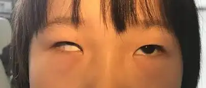 5岁女娃"歪头杀",虽然可爱却是病,治疗不及时危害也不小