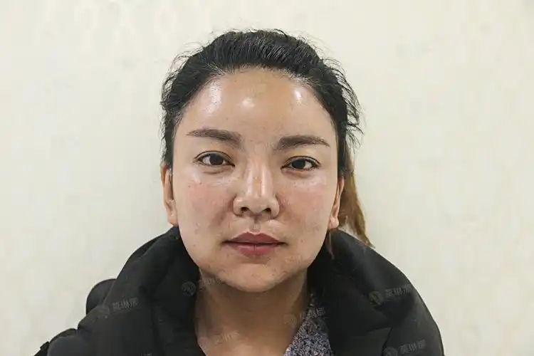 面部脂肪填充案例日记