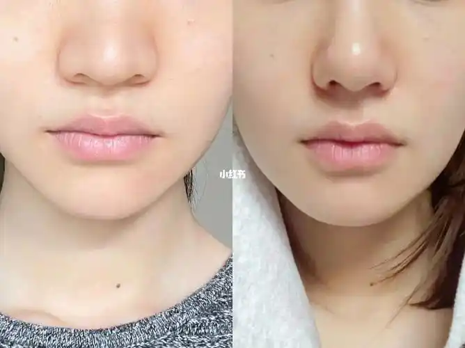 缩鼻翼 鼻头42天细节对比