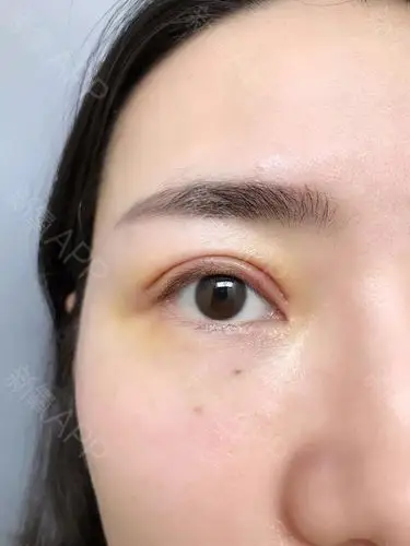 埋线双眼皮修复上睑提肌术后即刻
