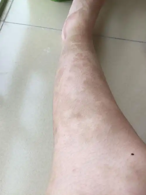 腿上突然长了这么多黑斑,不痛不痒的,在光线充足的情况下特别明显