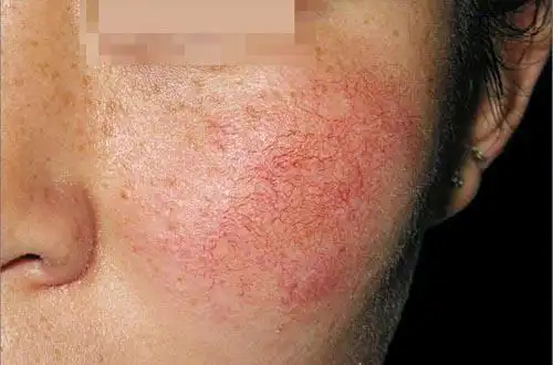 护肤之 面部红血丝篇