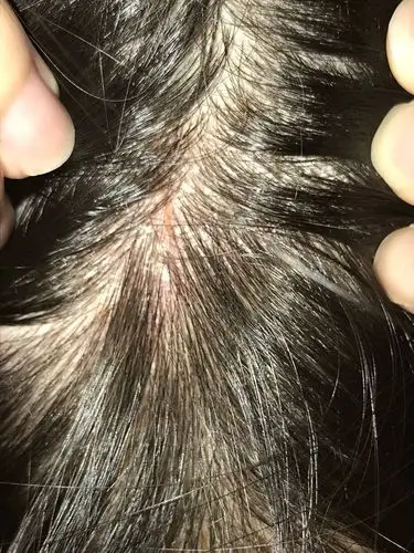 头皮痒 还红 有头皮屑 怎么回事