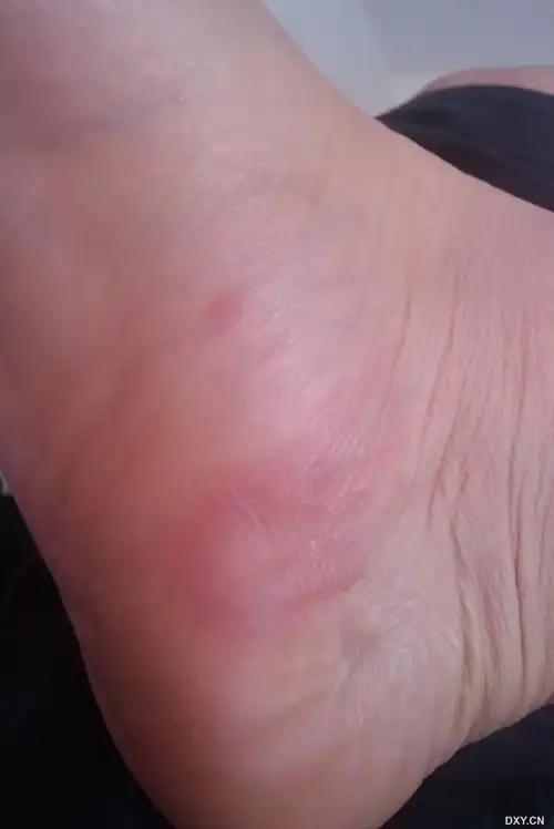 【求助】脚上红斑