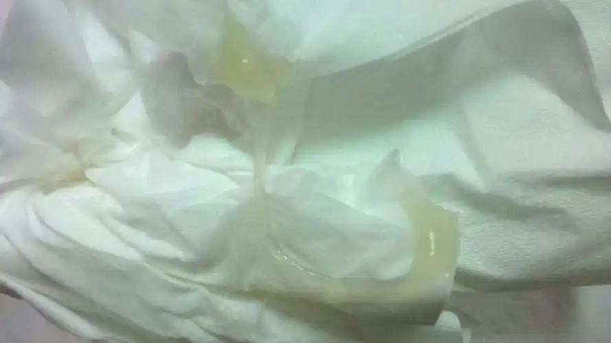 这样的白带是脓性白带吗