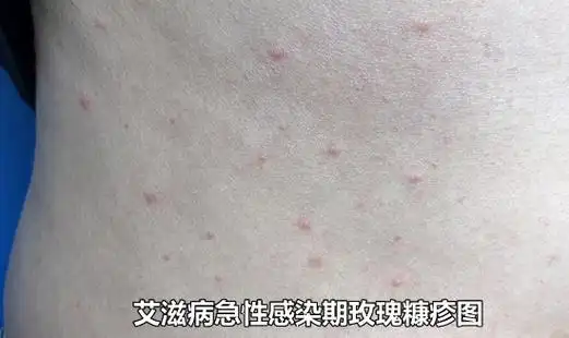 艾滋病初期小红点照片 出现的一种皮损表现