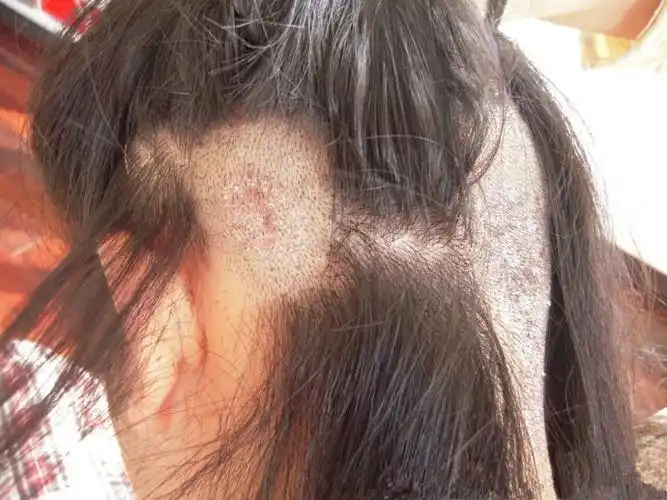 女生的头癣初期图片_有来医生