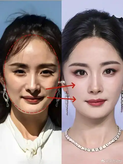 脂肪填充适合什么基础?看杨幂就知道!