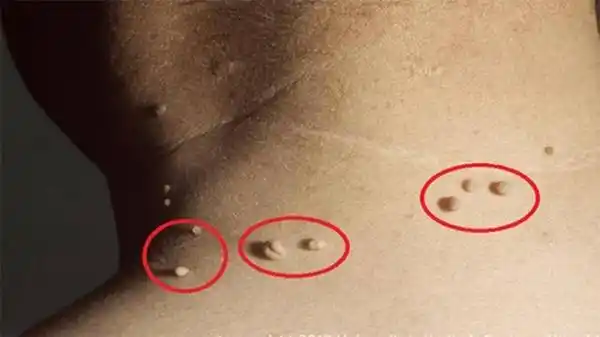皮肤上长出一颗「小肉瘤」:学会善用一种「天然成分」,不需手术,轻松