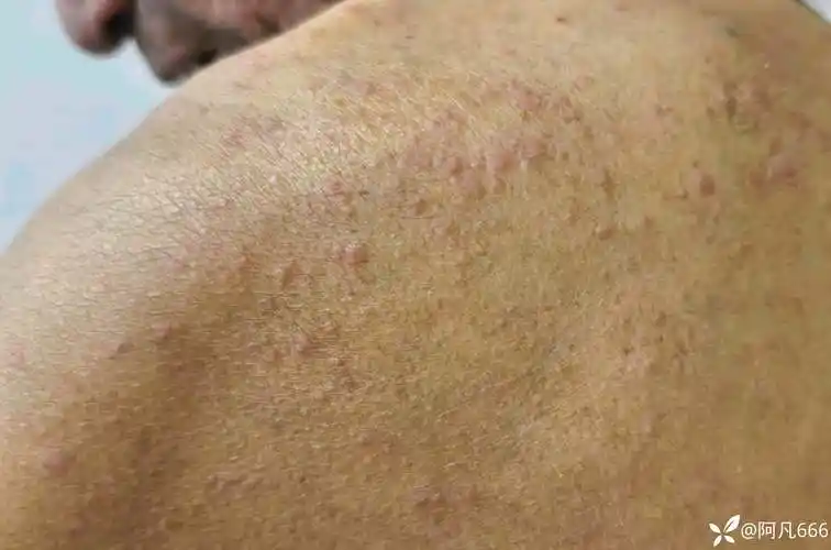 男 66岁,全身间断出现皮疹11年,伴部分皮疹面有出血点,瘙痒