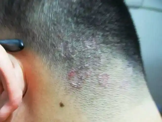 恐怖!湖北男子后脑勺上长出50条蛆虫!竟是因为他的一个平常动作.