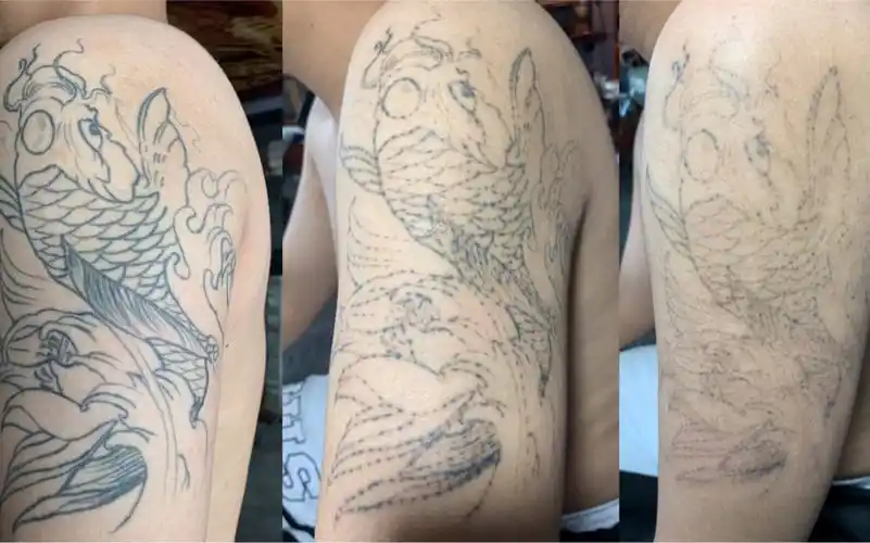 洗纹身对比图,济南小哥哥大臂清洗第3次真实记录