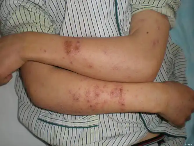 【共享】常见皮肤疾病典型图片 [精华] [病例帖]