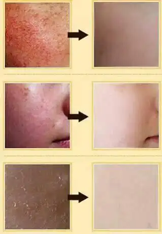 有红血丝的人可以做面部拔筋排毒吗