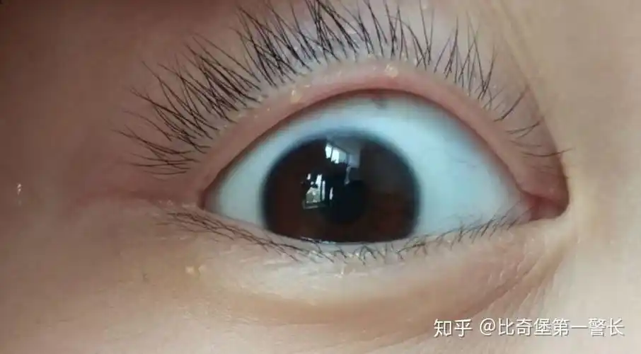 眼睑起了个小泡是怎么了?如图?