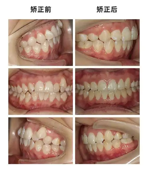 不是所有的虎牙都是可爱的