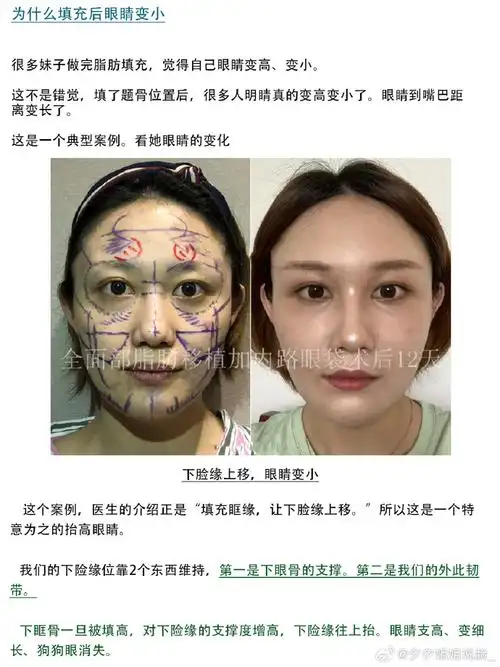 『功课』脂肪填充的审美!