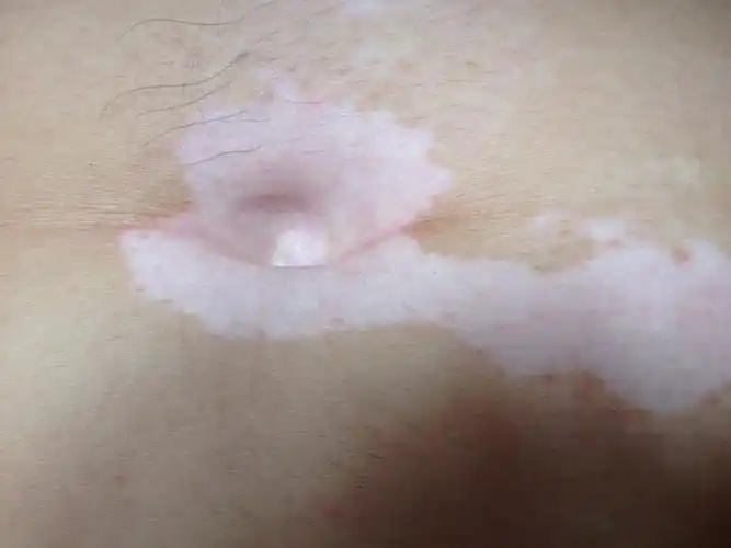 身上多处有白斑有十多年无病无痒没有任何的不适最近近丶几年变多