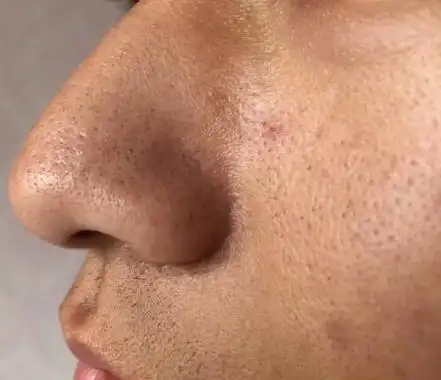 男生毛孔粗大,皮肤很黑很粗糙,怎么办?