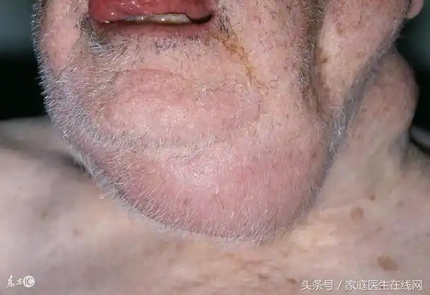 多会有5个表现,真的不能掉以轻心(腋下淋巴癌早期症状) - 趣测网