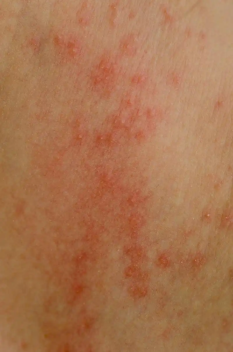 皮肤角质层受损怎么修复皮肤红  皮肤是我们身体最大的器官,它的外层