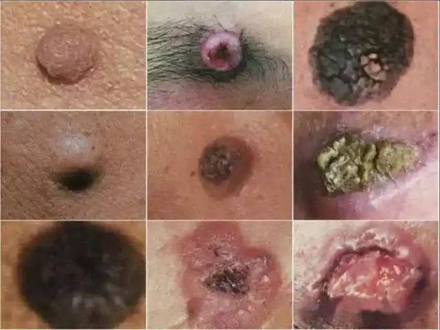 恶性皮肤肿瘤当心你的皮肤出现这种表现