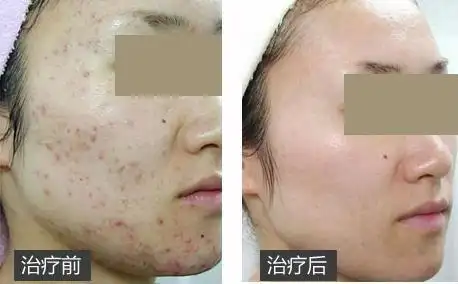 【果酸换肤前后  对比照】