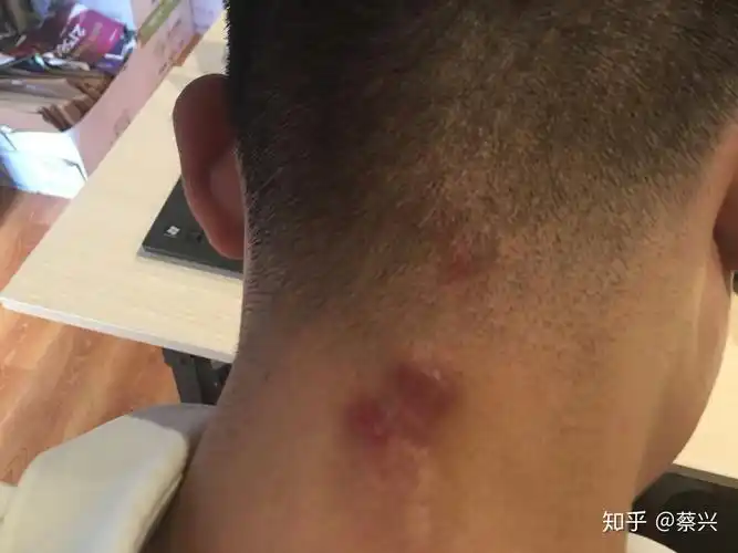 脖子上长了藓帮忙看看