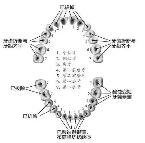 19岁高中生一口牙齿拔掉8颗折断10颗这个习惯说不定你也有