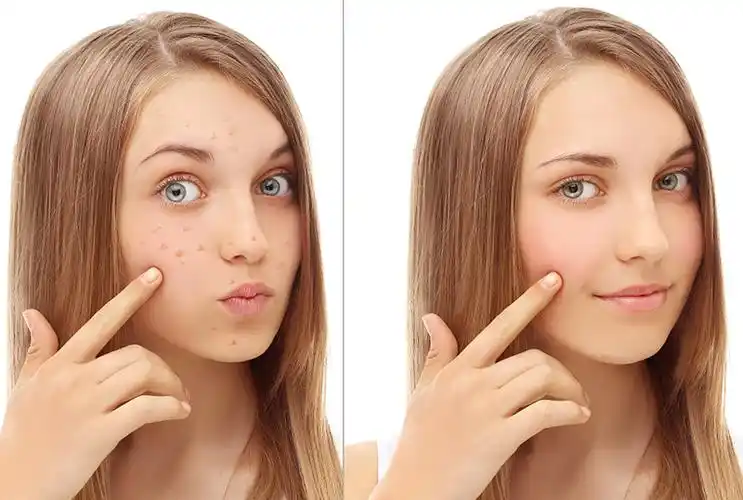 油性痘痘肌该咋办?原来只需这么做