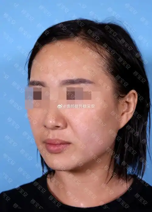 计划##穆宝安教授#  和大家分享案例后续:吕女士,36岁,皮肤弹性较差