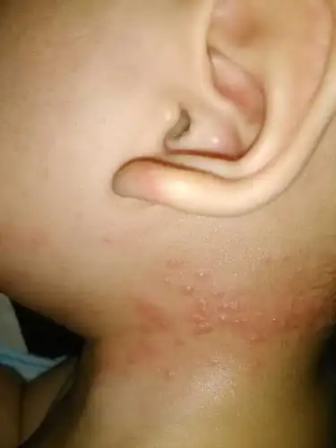 过敏宝宝 - 妈妈帮