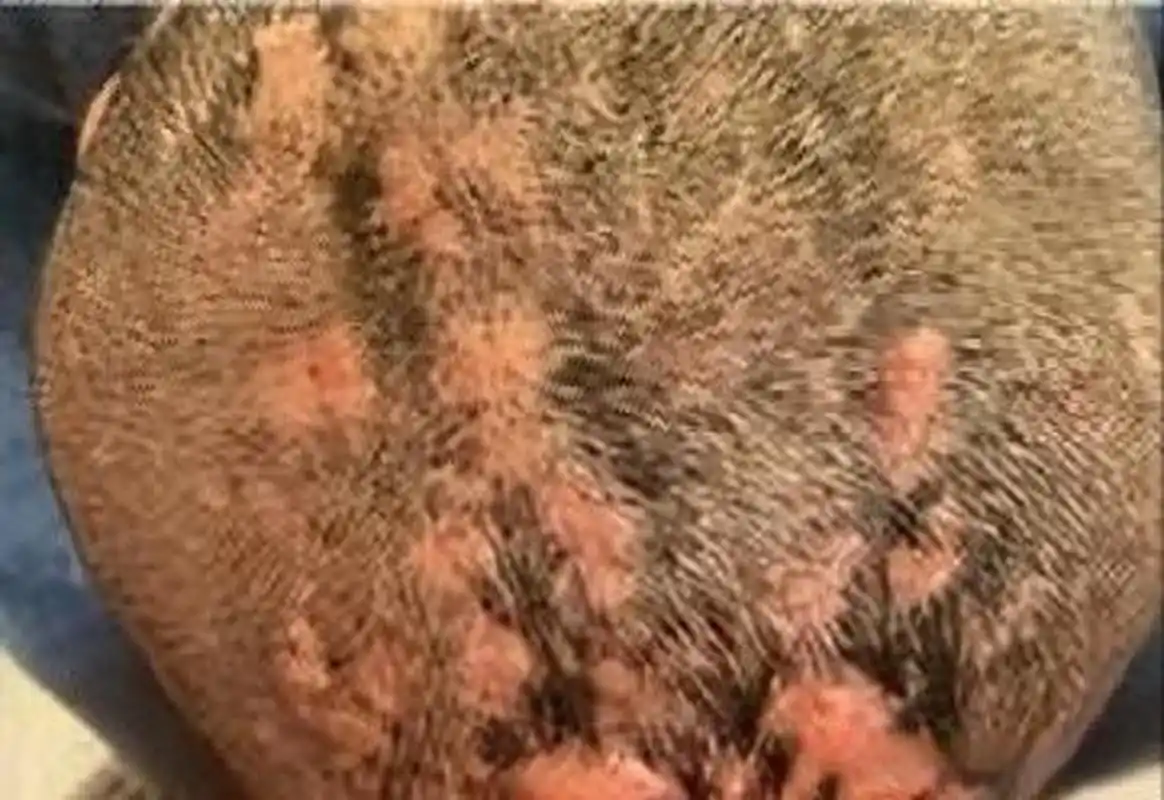 有个35岁的男患者,头上长了好多脓包,毛囊炎折腾了好几年都没见好转.